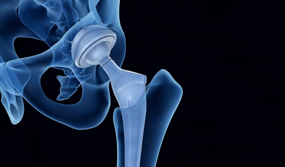x-ray of an artificial joint implanted using the anterior approach to hip surgery