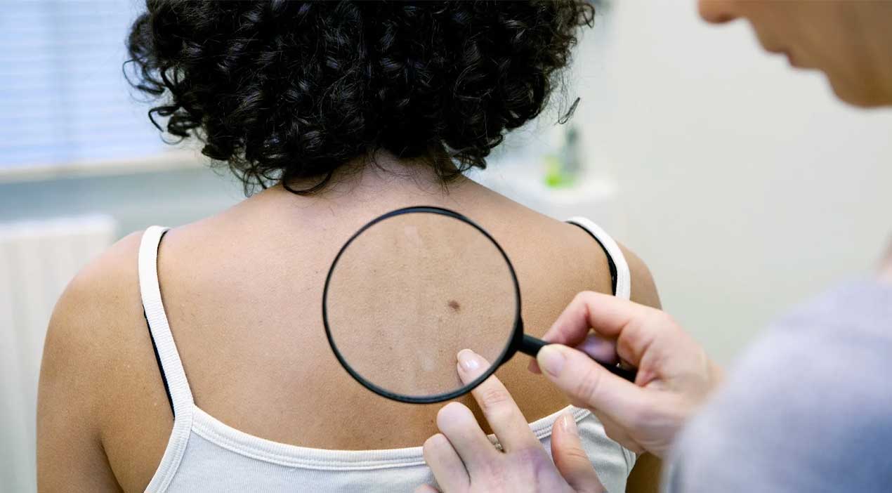 Skin Cancer Check 