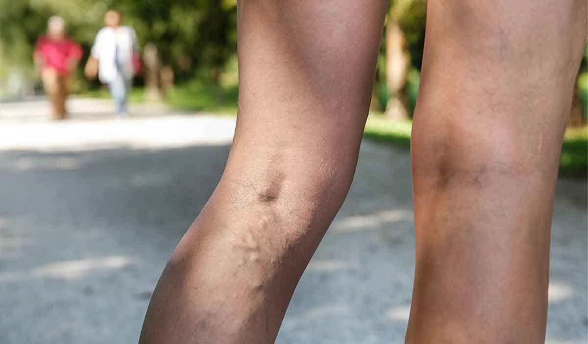 woman-with-varicose-veins-at-a-park
